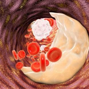 Coronary artery atherosclerosis